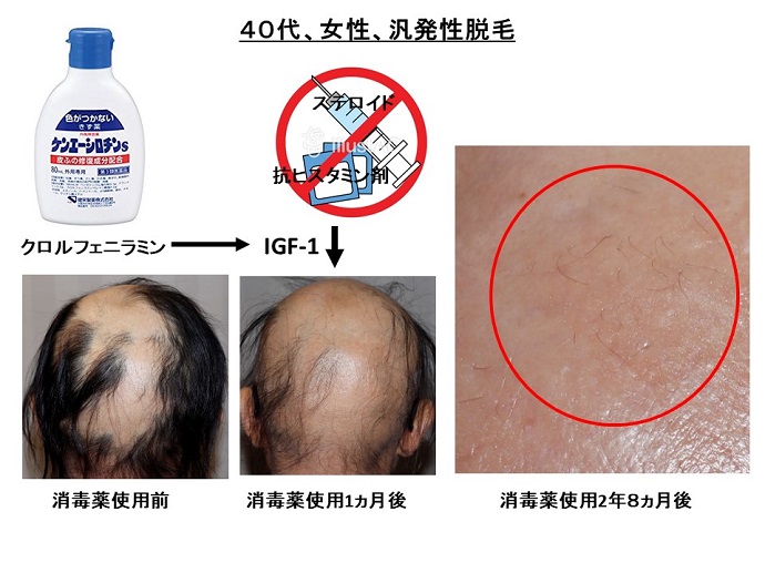 円形脱毛症　病院